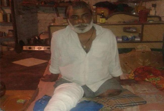 कई डॉक्टरों ने कह दिया था काटना पड़ेगा पैर, ढाई साल बाद बिलकुल ठीक