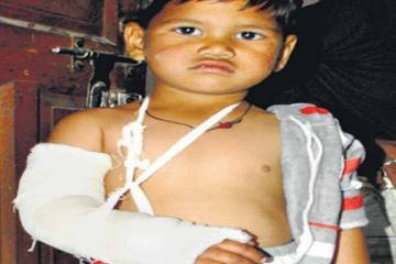 बाएं की जगह दाएं हाथ में लगाया प्लास्टर, पहले भी विवाद में रहा है ये हॉस्पिटल