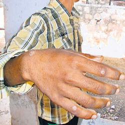 Rawatbhata spread infection in animals, Cattle are also affected